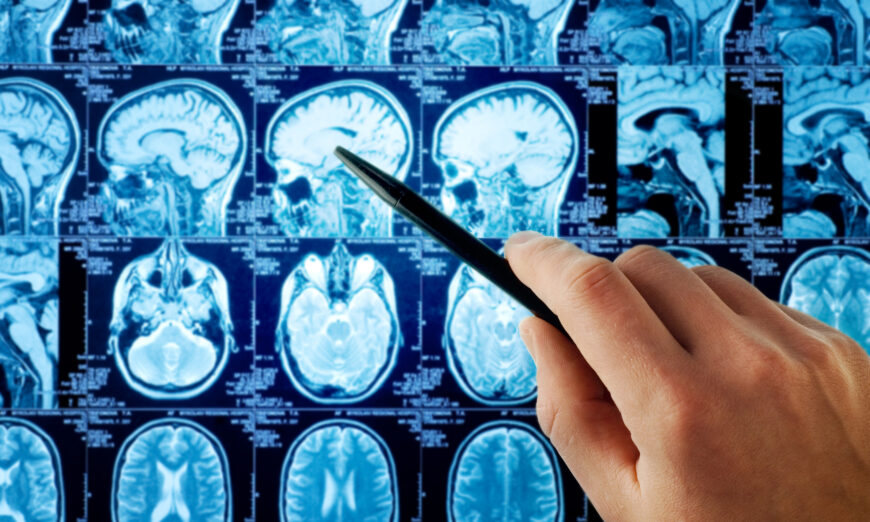 Thể tích tổn thương lớn được tìm thấy nhiều hơn ở những người dùng calcium so với những người không dùng.(Ảnh: Triff/Shutterstock)