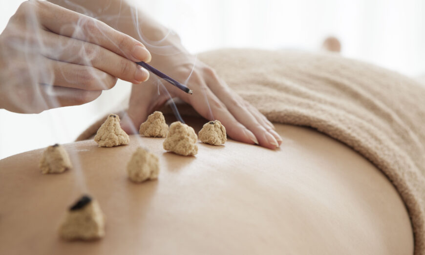 Đốt ngải là một hình thức trị liệu bằng nhiệt, trong đó nguyên liệu thực vật khô là “ngải cứu” được đốt cháy trên hoặc rất gần bề mặt da. Trong Trung y, châm cứu và đốt ngải được dùng riêng lẻ hoặc kết hợp với nhau để điều trị bệnh. (Ảnh: Shutterstock)