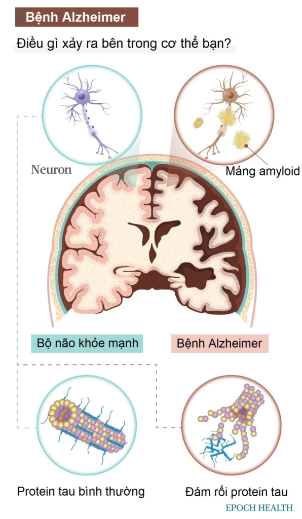 Hướng dẫn cơ bản về bệnh Alzheimer: Triệu chứng, nguyên nhân, điều trị, và giải pháp tự nhiên