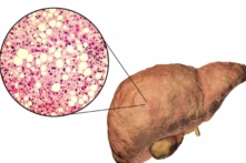 Triệu chứng sớm của gan nhiễm mỡ (Shutterstock)