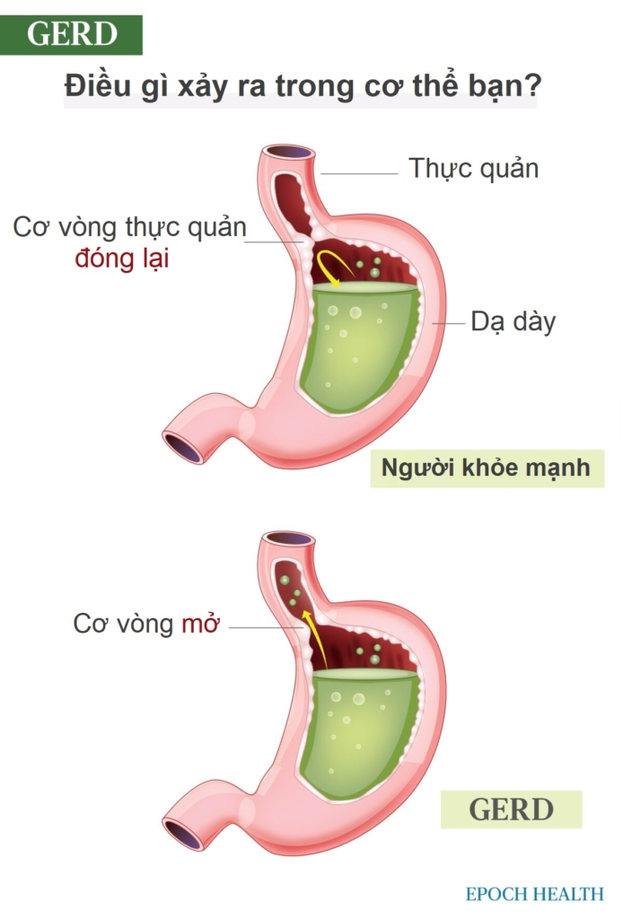 Trào ngược acid và GERD: Triệu chứng, nguyên nhân, điều trị, và các giải pháp tự nhiên