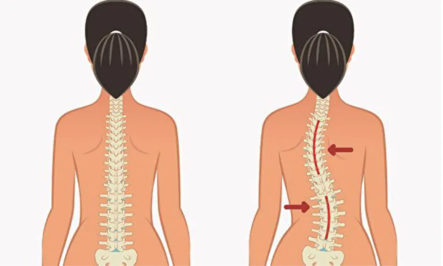 Tư thế không đúng dễ gây cong vẹo cột sống. Cách điều chỉnh? (Ảnh: Shutterstock)