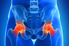 Đau hông có thể dễ dàng làm giảm chất lượng cuộc sống và hạn chế khả năng vận động. Xấu hơn, đau một bên hông khiến [bên đối diện] phải hoạt động bù quá mức và phát triển các dáng đi không phù hợp có thể dẫn đến các vấn đề khác.(Ảnh: SciePro/Shutterstock)