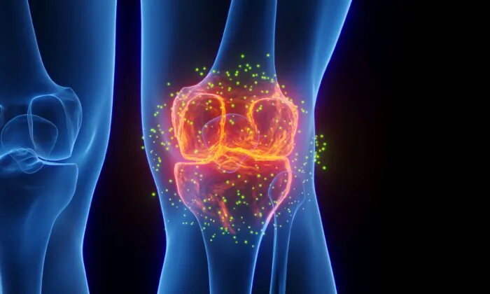 Đau đầu gối kinh niên: Nguyên nhân gây đau đứng hàng thứ hai, 5 bài tập giảm đau đơn giản tại nhà