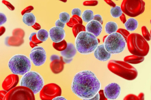 Bệnh bạch cầu cấp dòng lympho, xét nghiệm tủy đồ. (Ảnh: Kateryna Kon/Shutterstock)