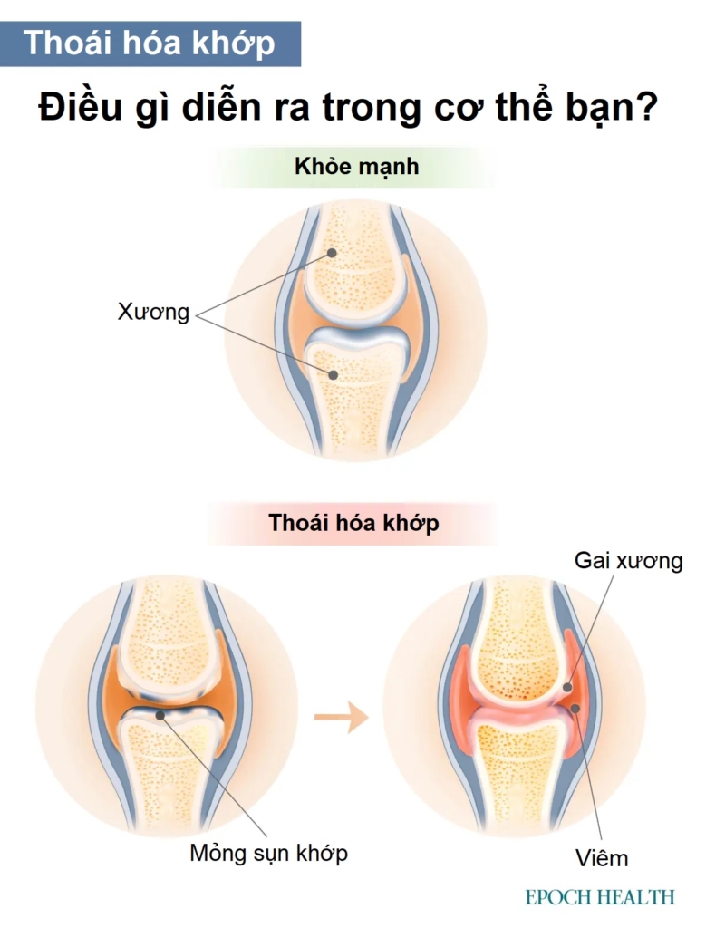 Hướng dẫn cơ bản về bệnh thoái hóa khớp: Triệu chứng, nguyên nhân, phương pháp điều trị và cách tiếp cận tự nhiên