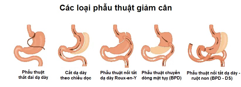 Kiểm soát cơn đói - Phần 1