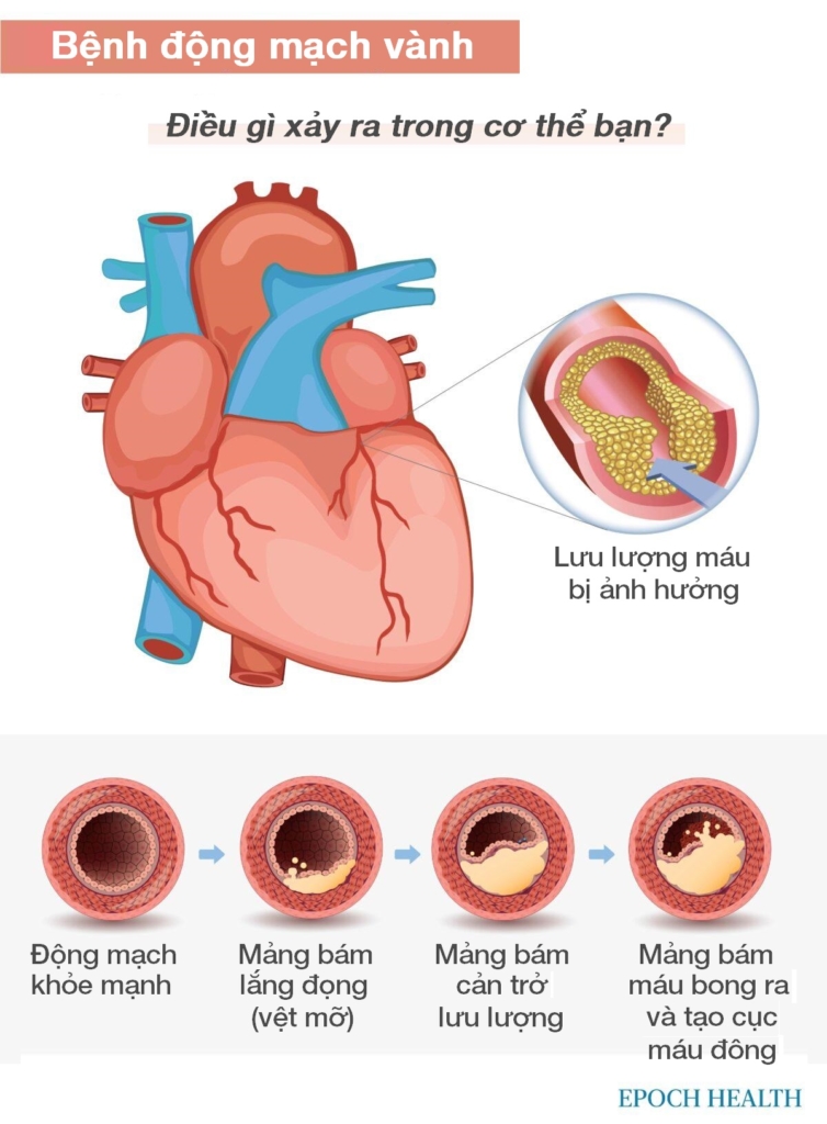 Hướng dẫn cơ bản về bệnh tim: Triệu chứng, nguyên nhân, điều trị và các liệu pháp tự nhiên