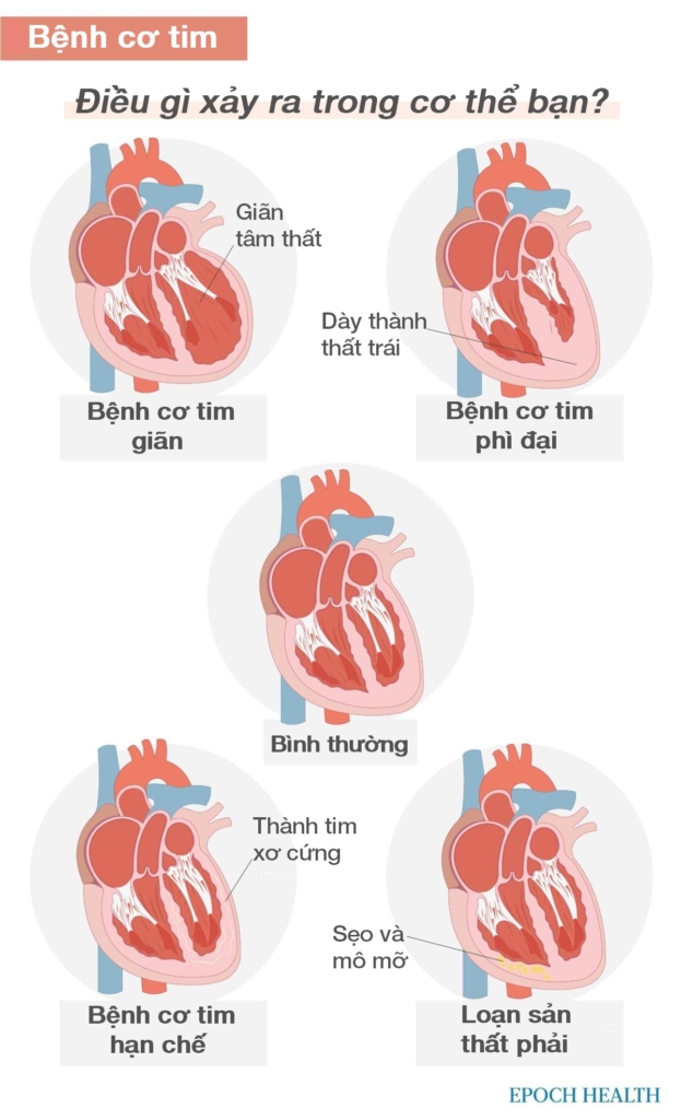 Hướng dẫn cơ bản về bệnh tim: Triệu chứng, nguyên nhân, điều trị và các liệu pháp tự nhiên