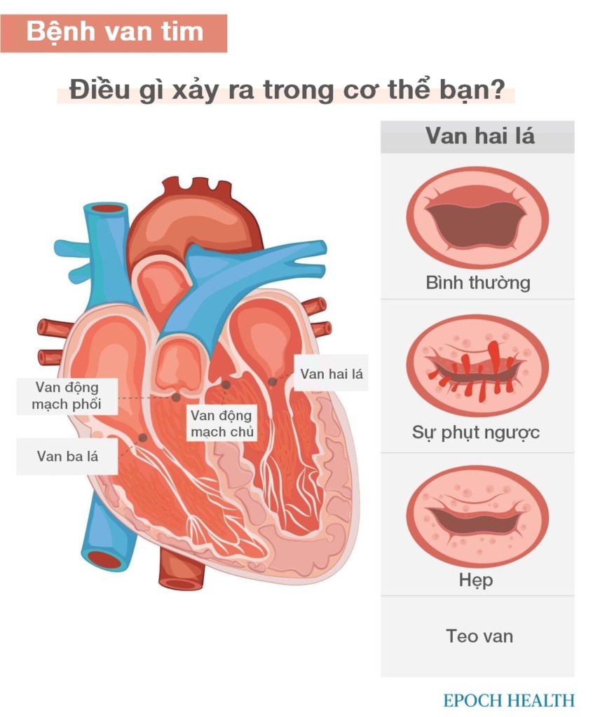Hướng dẫn cơ bản về bệnh tim: Triệu chứng, nguyên nhân, điều trị và các liệu pháp tự nhiên