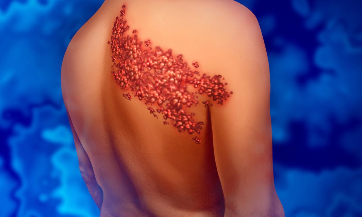 Vô số triệu chứng về da hậu vaccine COVID được báo cáo, đã có giải pháp