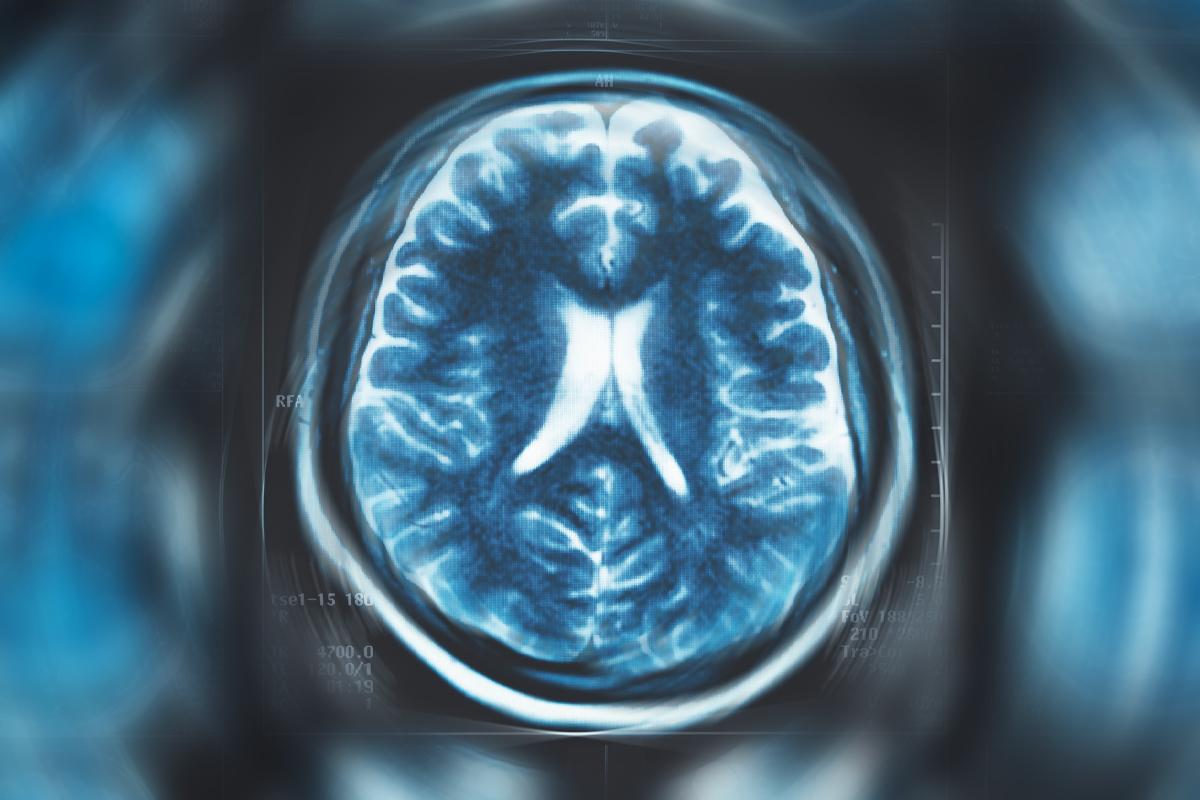 Mối liên quan giữa cô đơn và nguy cơ bị bệnh Parkinson