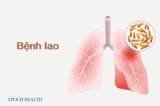 Hướng dẫn cơ bản về bệnh lao: Triệu chứng, nguyên nhân, điều trị và phương pháp tiếp cận tự nhiên