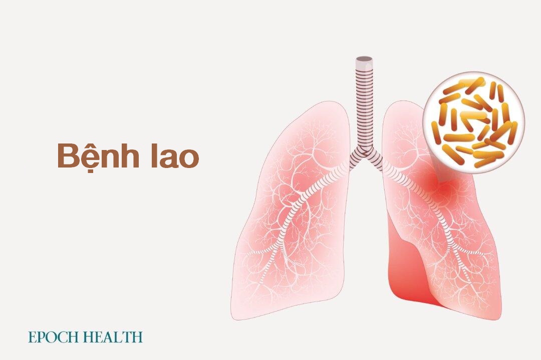 Hướng dẫn cơ bản về bệnh lao: Triệu chứng, nguyên nhân, điều trị và phương pháp tiếp cận tự nhiên