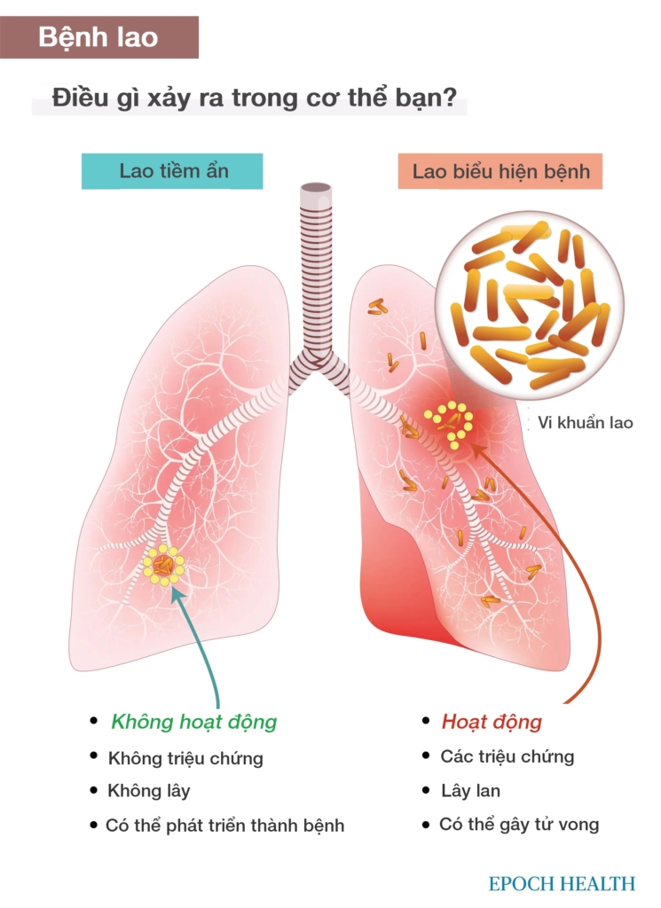 Hướng dẫn cơ bản về bệnh lao: Triệu chứng, nguyên nhân, điều trị và phương pháp tiếp cận tự nhiên