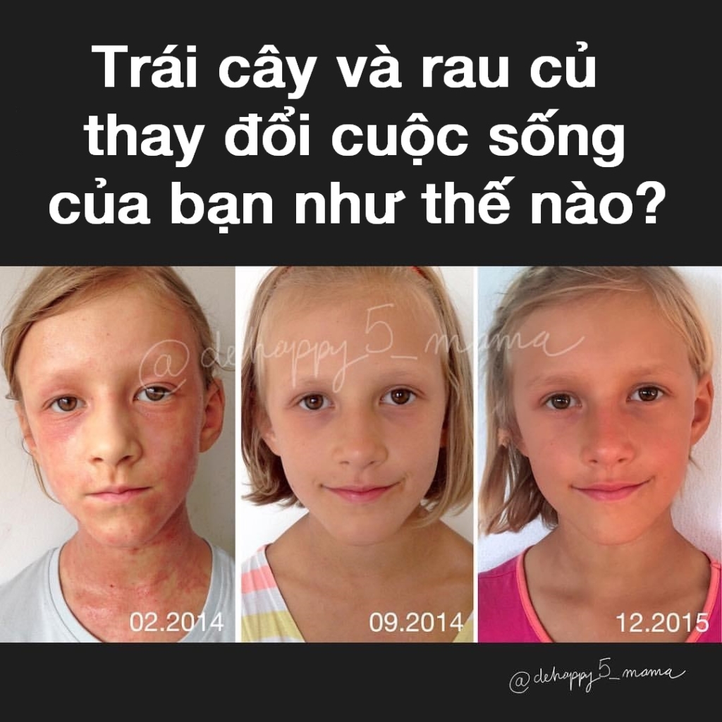 Cách chữa bệnh chàm nặng: người mẹ dùng khẩu phần ăn thuần chay thô từ trái cây và rau củ cho con gái