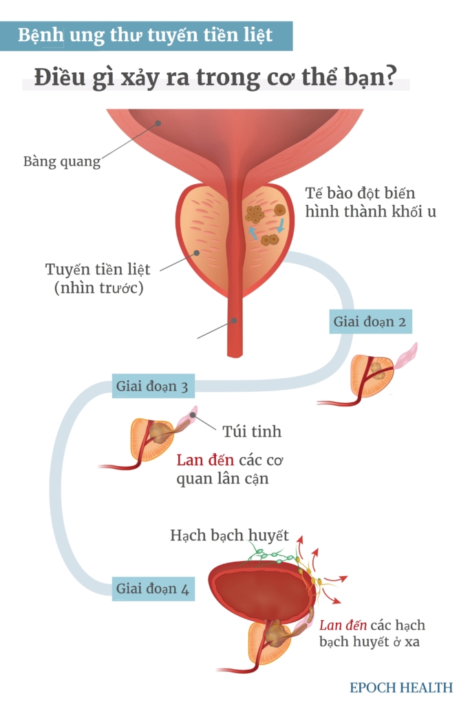 Hướng dẫn cơ bản về bệnh ung thư tuyến tiền liệt: Triệu chứng, nguyên nhân, phương pháp điều trị và phương pháp tiếp cận tự nhiên