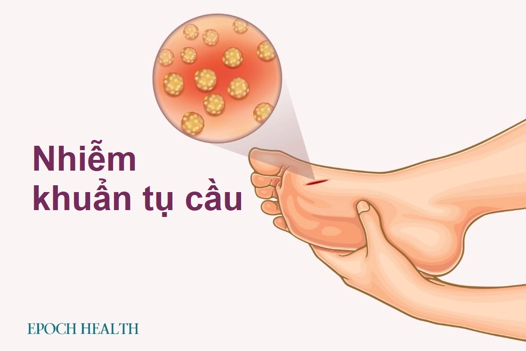 Hướng dẫn cơ bản về nhiễm khuẩn tụ cầu: Triệu chứng, nguyên nhân, điều trị và phương pháp tiếp cận tự nhiên