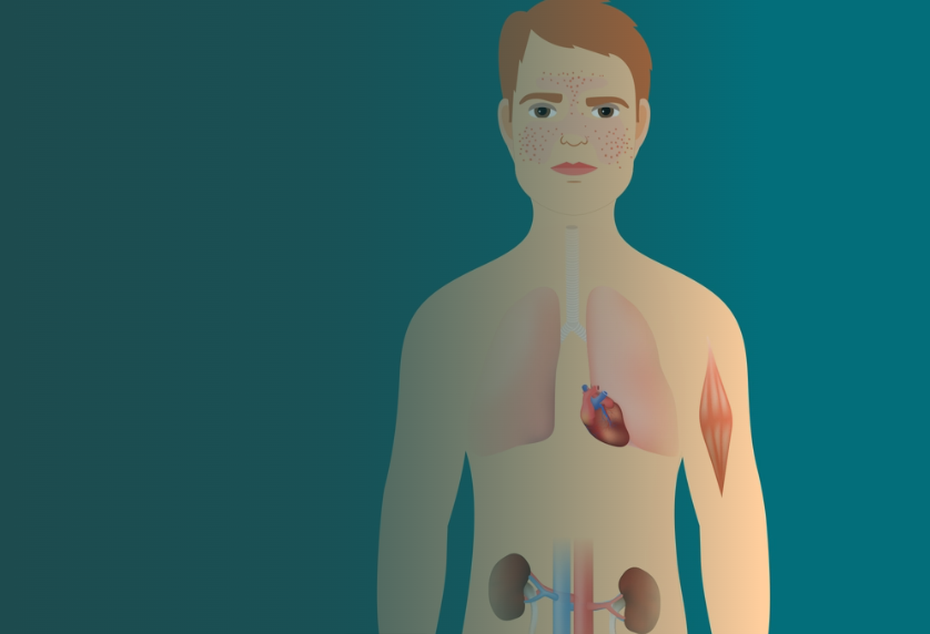 Sáu bài tập trị liệu giúp kiểm soát bệnh lupus