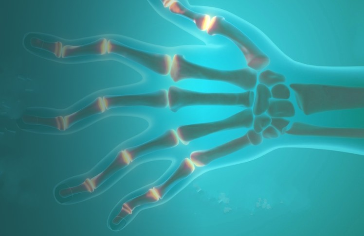 Năm bài tập kiểm soát bệnh viêm khớp dạng thấp