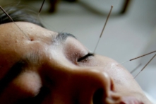 Liệu pháp châm cứu sử dụng những chiếc kim nhỏ để cân bằng lại năng lượng âm dương. (Ảnh: China Photos/Getty Images)