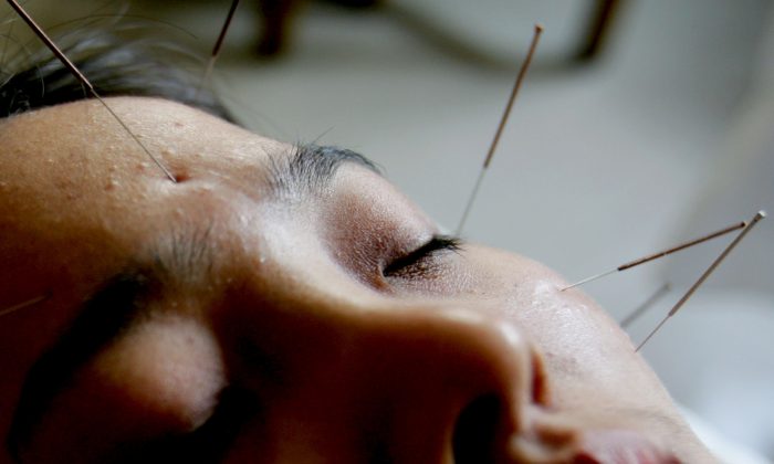 Liệu pháp châm cứu sử dụng những chiếc kim nhỏ để cân bằng lại năng lượng âm dương. (Ảnh: China Photos/Getty Images)