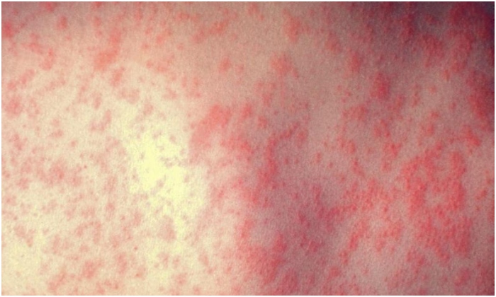 bệnh Sởi ở Sài Gòn