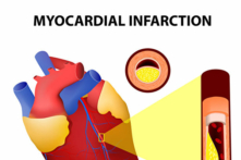 Khi hai yếu tố vận động và tức giận cùng xảy ra một lúc thì khả năng phát sinh nhồi máu cơ tim cấp tính sẽ cao hơn. (Ảnh: Fotolia)