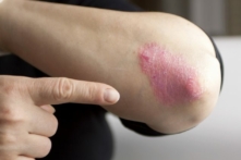 Bệnh vẩy nến (Ảnh: Hriana/Shutterstock)