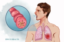 Không có phương pháp chữa khỏi bệnh hen, nhưng có thể kiểm soát các triệu chứng của bệnh qua điều trị thích hợp. (Ảnh: The Epoch Times, Shutterstock)