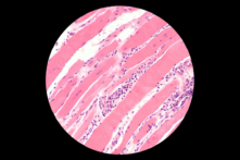 Giải phẫu bệnh của tự miễn dịch ở cơ, trong đó các tế bào miễn dịch tấn công cơ. (Ảnh: David A Litman/Shutterstock)