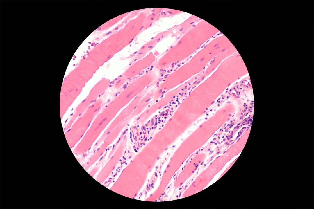 Giải phẫu bệnh của tự miễn dịch ở cơ, trong đó các tế bào miễn dịch tấn công cơ. (Ảnh: David A Litman/Shutterstock)
