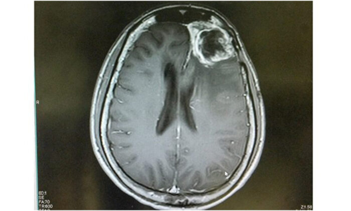 Hình ảnh khối u nguyên bào thần kinh đệm trên cộng hưởng từ. (Ảnh: ShutterStock)