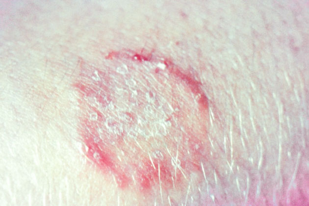 Ảnh về nhiễm nấm da. (Ảnh: CDC/ Tiến sĩ Lucille K. Georg)