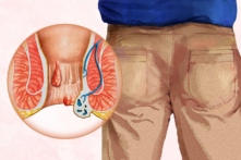 Khoảng một nửa số người từ 50 tuổi trở lên bị bệnh trĩ. (Minh họa của The Epoch Times, Shutterstock)